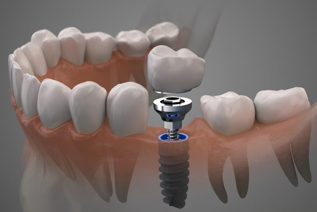 Dental Implant